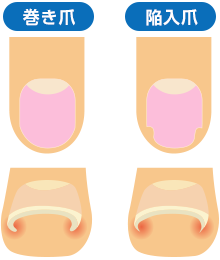 陥入爪・巻き爪