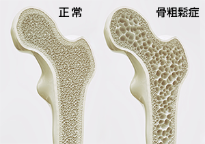 骨粗しょう症とは